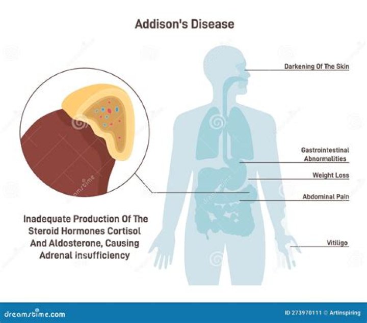 addison