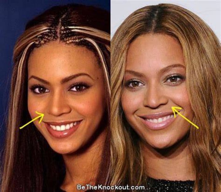 Beyonce Nose Job