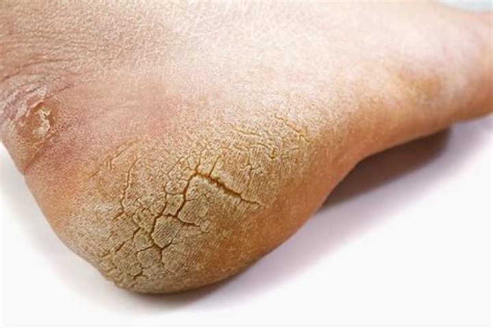 cracked-heel