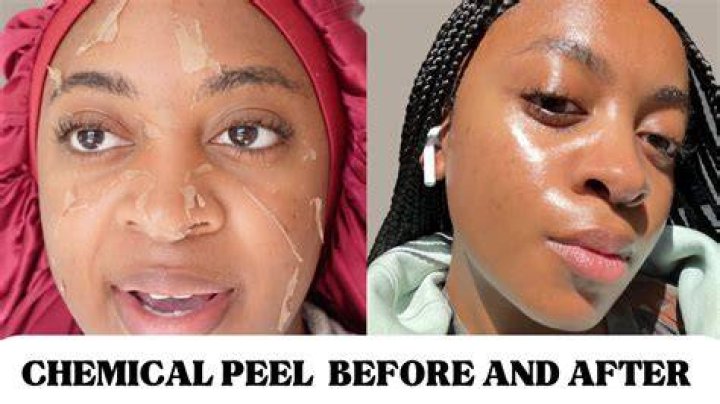 face peel