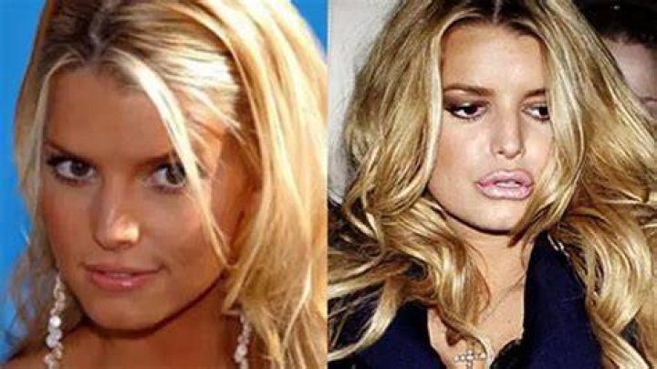 Jessica Simpson Lip Fillers