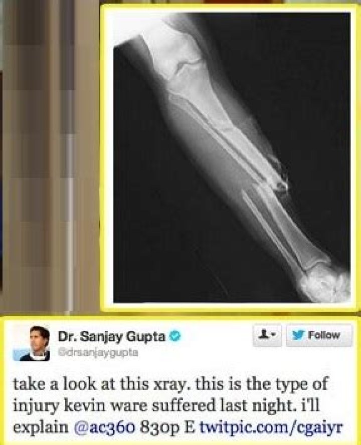 Kevin Ware X Ray