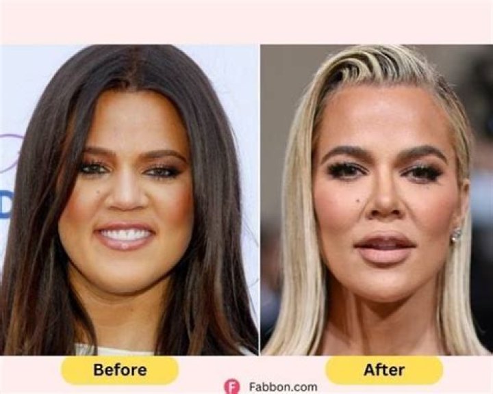 Khloe Kardashian Fillers