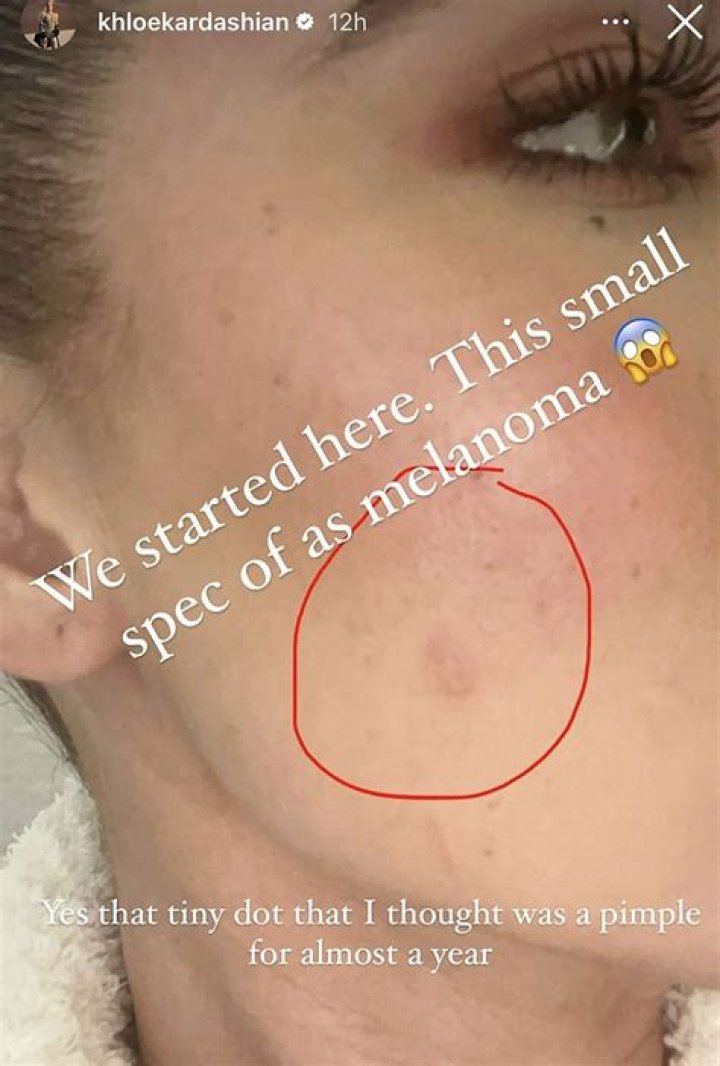 khloe kardashian melanoma