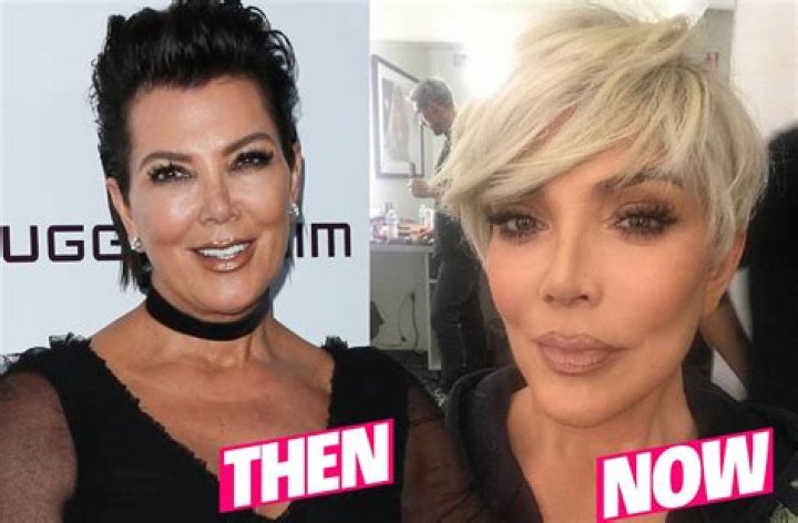 Kris Jenner Plastic Surgery Lips