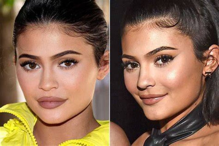 Kylie Jenner Lip fillers