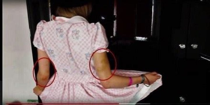 Marina Joyce Bruises