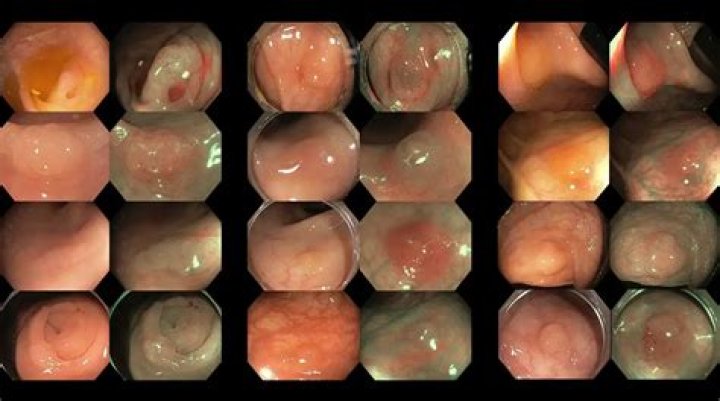 Real Colon Cancer