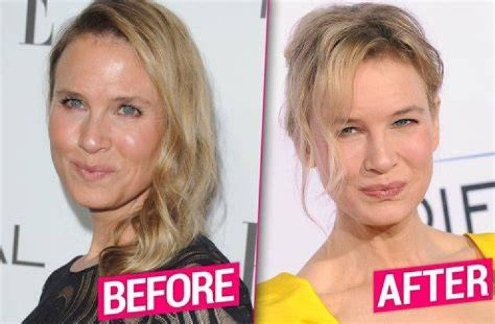 Renee-Zellweger-face-change-