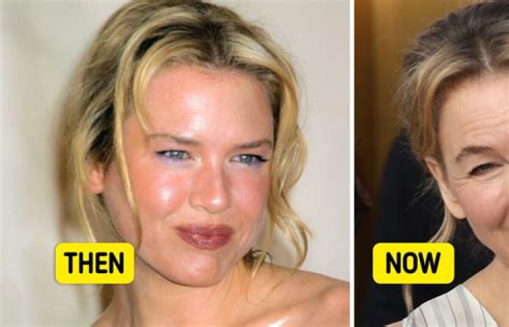 Renee Zellweger Lip Injections